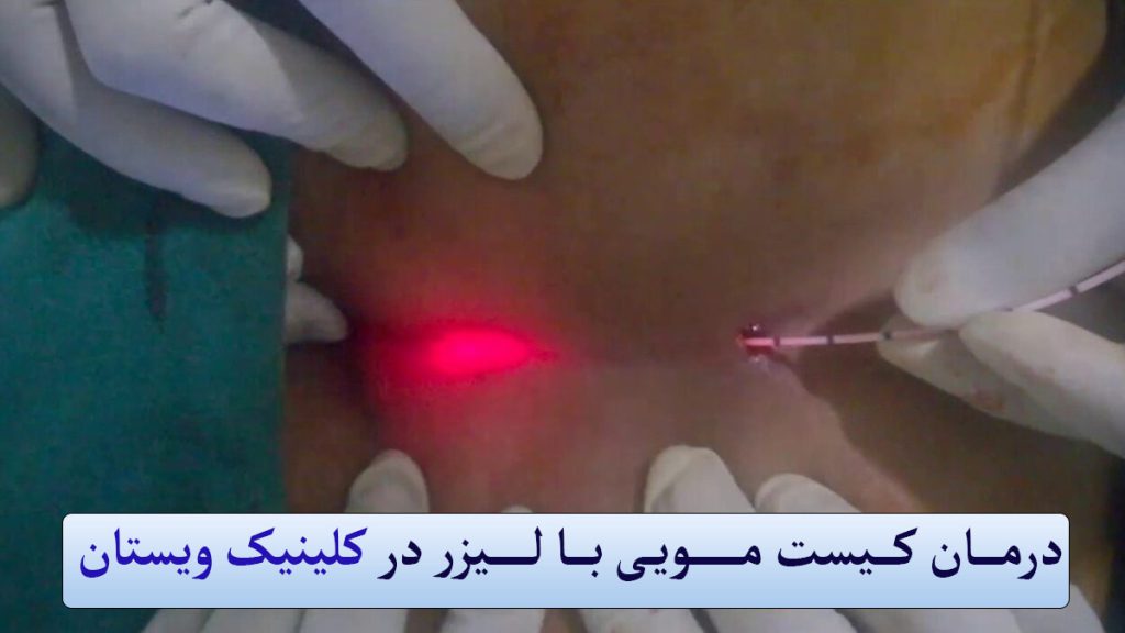 درمان کیست مویی با لیزر از لیزر برای درمان کیست مویی استفاده می شود