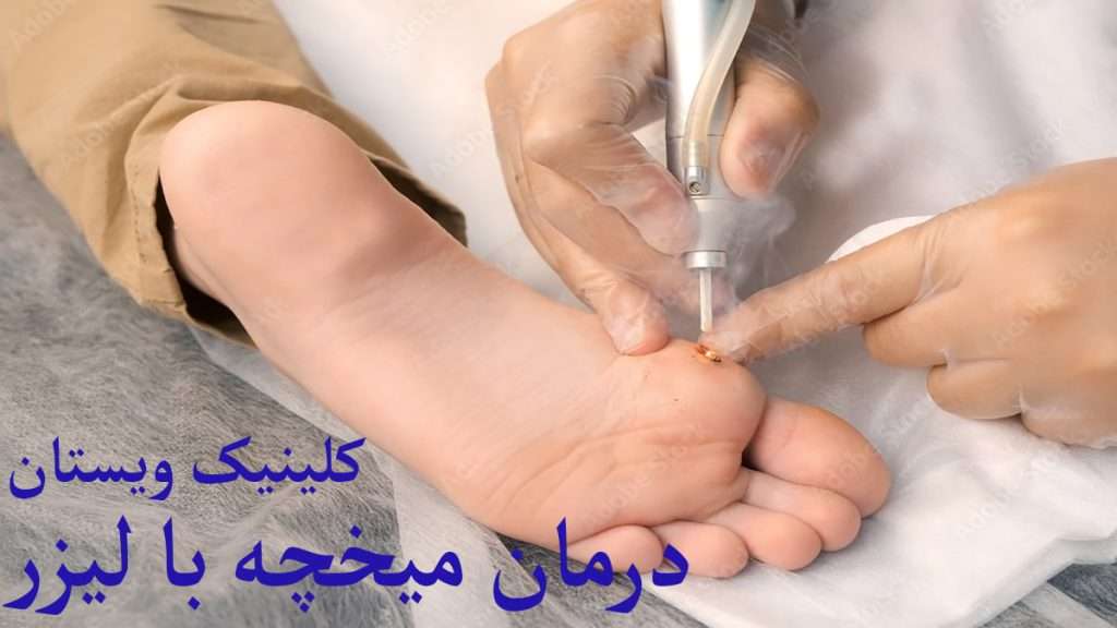 درمان میخچه با لیزر پزشک از لیزر برای درمان میخچه استفاده می کند