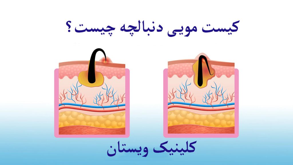 کیست مویی کیست مویی دنبالچه نمایش داده می وشد