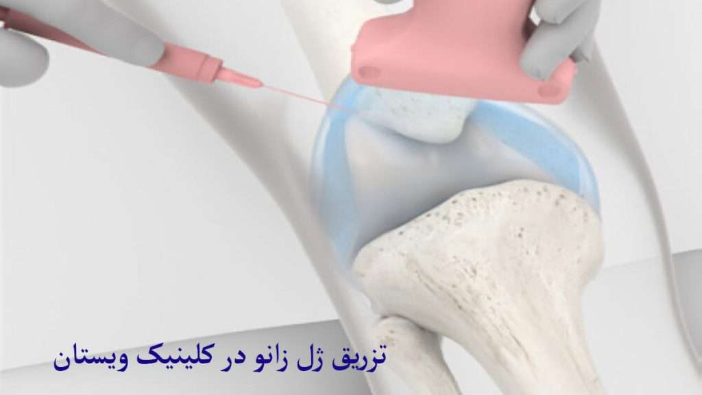 تزریق ژل زانو تزریق ژل زانو با سرنگ