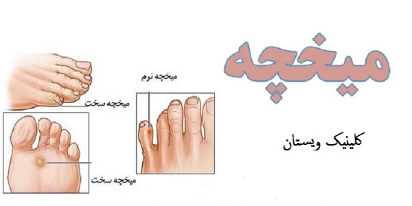 انواع مختلف میخچه نشان داده شده است