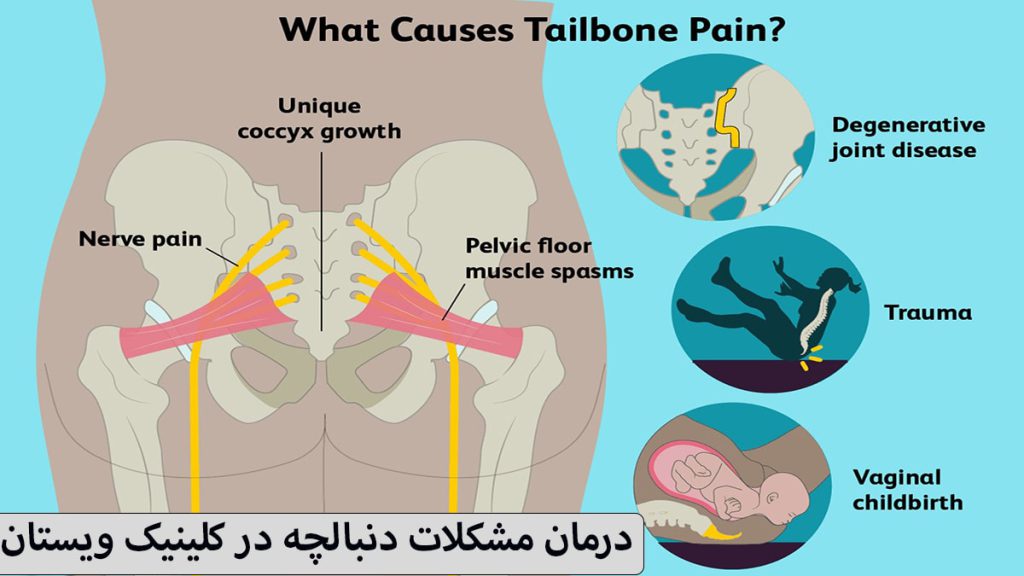علل در رفتن دنبالچه مانند زمین خوردن ،فشار و زایمان در سمت راست و یک دنبالچه شخص نشان داده می شود