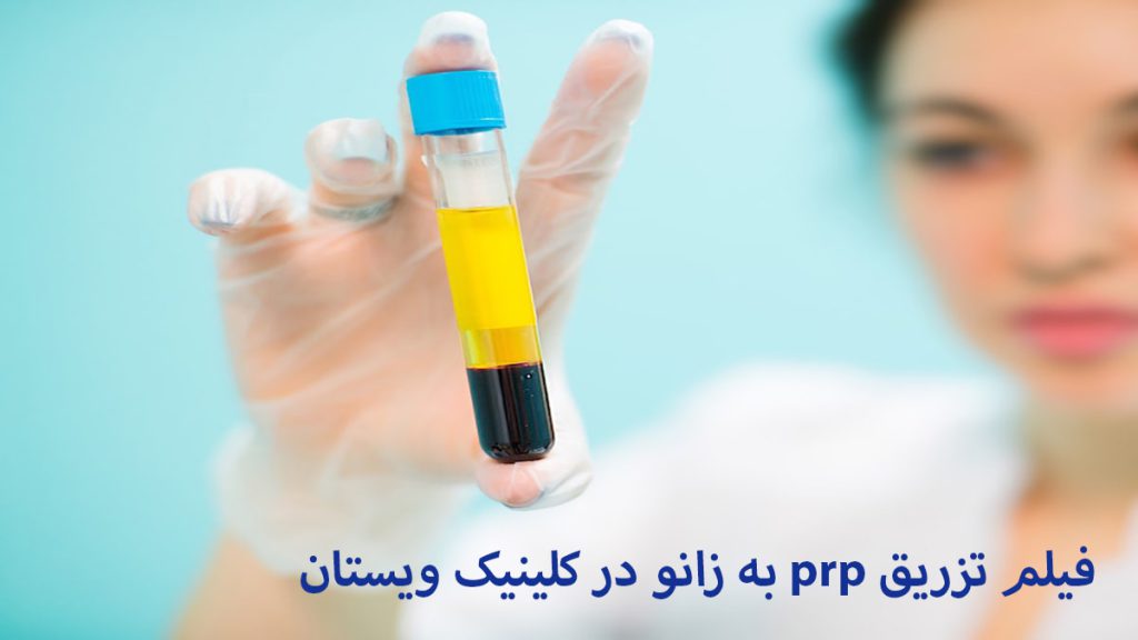 یک پزشک خانم که ظرف پزشکی حاوی پی آر پی را در دست دارد