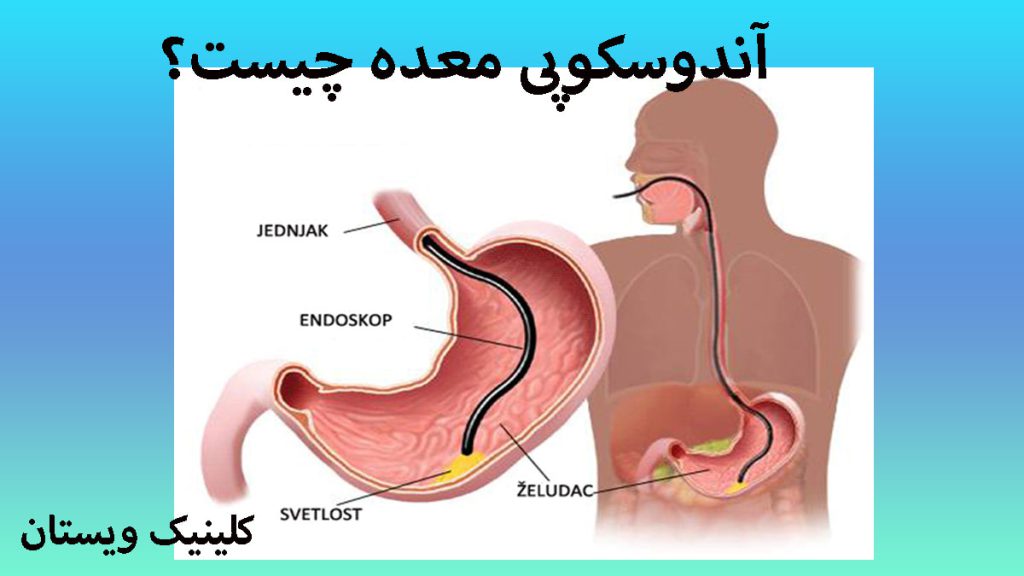 آندوسکوپی معده یک شخص و معده او که در حال انجام آندوسکوپی است