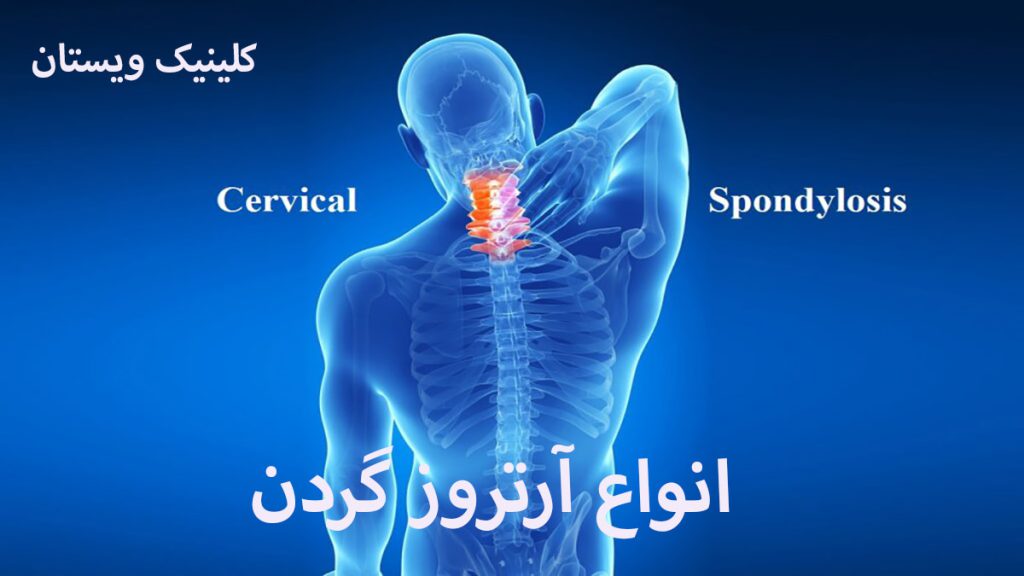 انواع آرتروز گردن اسکلت بدن فرد از زاویه پشت و درد در قسمت گردن