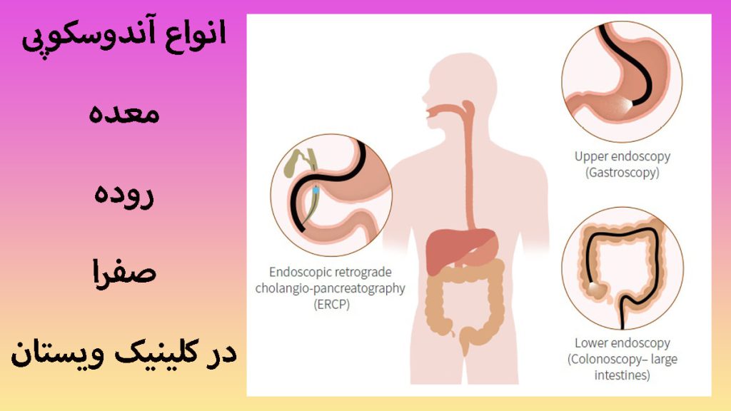انواع آندوسکوپی انواع آندوسکوپی معده و روده در سمت راست و نوشته ای با همین عنوان در سمت راست