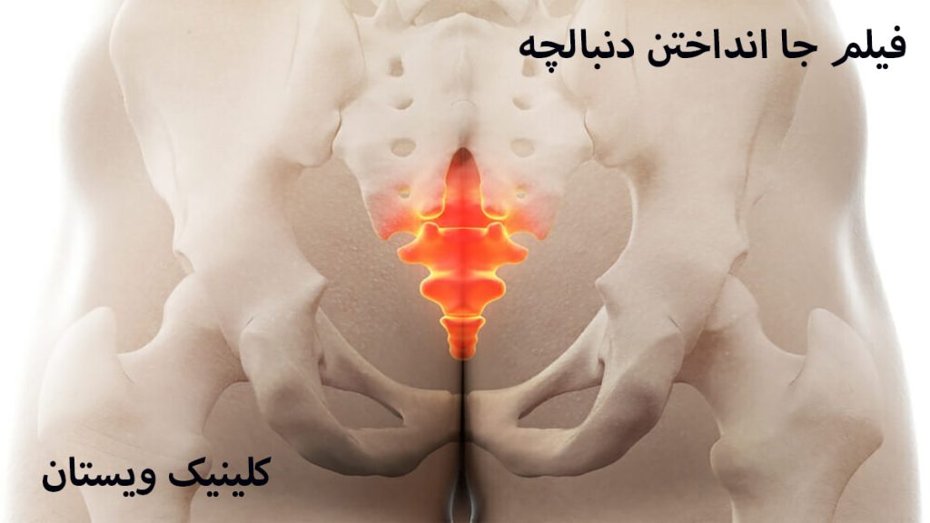 یک دنبالچه و یک نوشته با عنوان فیلم جا انداختن دنبالچه