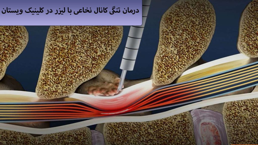 لیزر برای تنگی کانال نخاعی یک لیزر که برای درمان تنگی کانال نخاعی به کار گرفته شده است