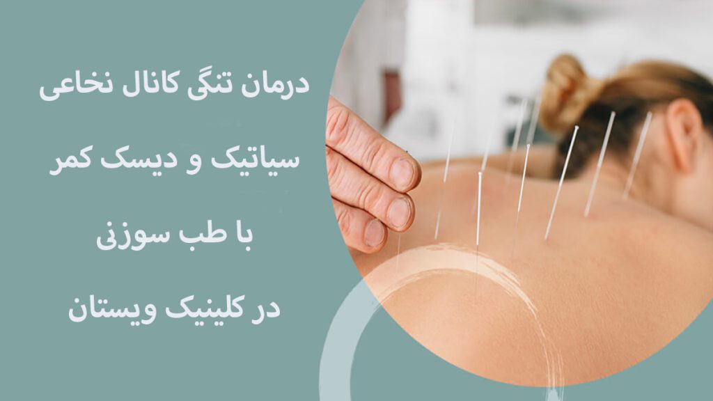 طب سوزنی برای کمرر انجام می شود.و نوشته ای با عنوان درمان تنگی کانال نخاعی با طب سوزنی