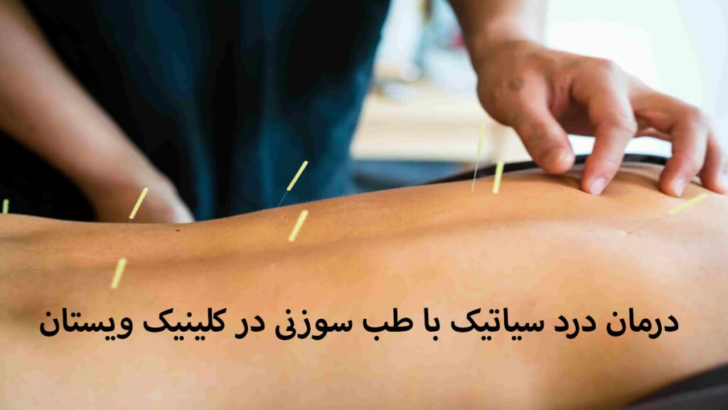 طب سوزنی کمر یک پزشک متخصص طب سوزنی در حال درمان درد کمر بیمار با این روش