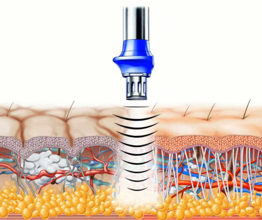 عملکرد دستگاه لیزر در درمان بیمای ها