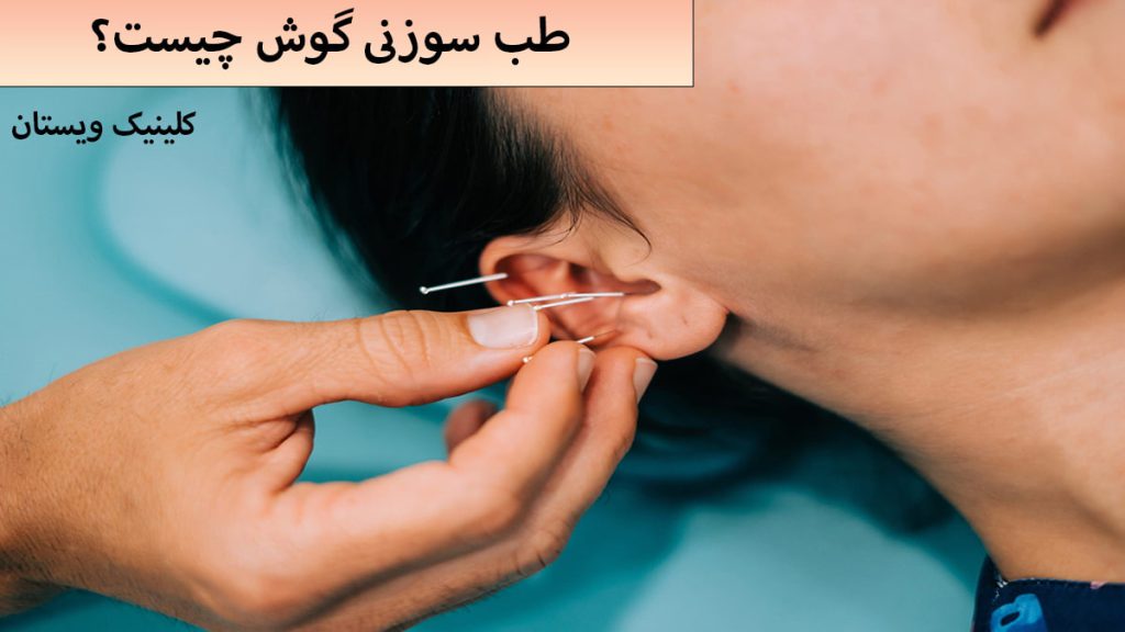 طب سوزنی گوش طب سوزنی برای گوش انجام می شود