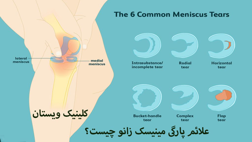 علائم پارگی مینیسک علائم پارگی مینیسک زانو- مفصل زانو در سمت چپ