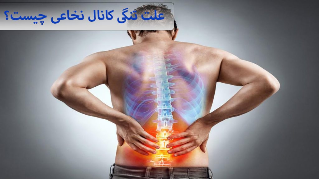 علت تنگی کانال نخاعی یک شخص که دچار درد کمر شده و ستون فقررات او با رنگ مشخص شده است
