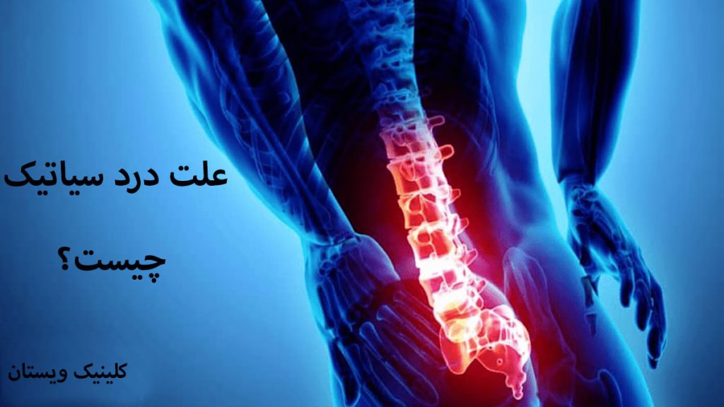 علت درد سیاتیک ستون فقرات یک فرد که در در قسمت کمر او نشان داده شده است
