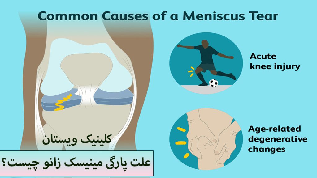 علت پارگی مینیسک زانو مفصل زانو و نوشته ای در خصوص علت پارگی مینیسک زانو