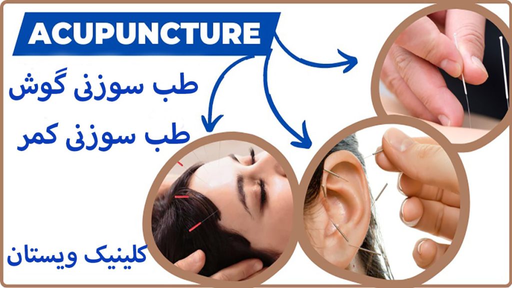 متخصص طب سوزنی موارد مختلف طب سوزنی گوش،بدن و صورت و نوشته ای با عنوان درمان تنگی کانال نخاعی با طب سوزنی