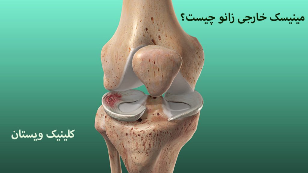 مینیسک زانو مفصل زانو و نوشته ای در خصوص مینیسک خارجی
