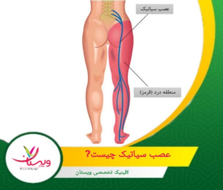 از نظر حسی، عصب سیاتیک و شاخههای آن مسئول انتقال حس از بخشهای مختلف پا هستند، از جمله پوست پشت ران، ساق پا، و کف پا. عصب سیاتیک چیست؟
