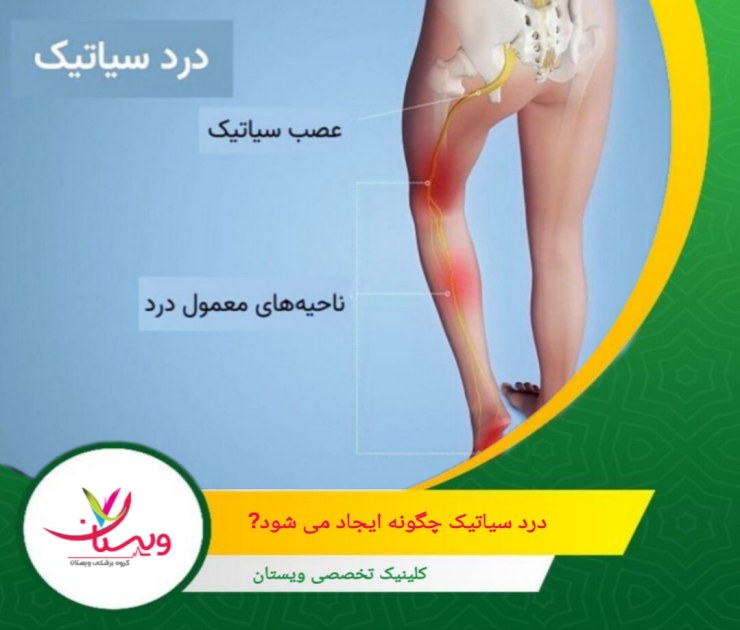 شایعترین علت درد سیاتیک، بیرونزدگی یا پارگی دیسک بینمهرهای در ناحیه کمر است. درد سیاتیک چگونه ایجاد میشود؟