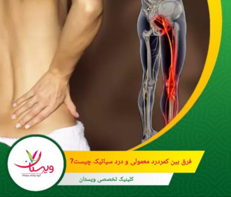 درد سیاتیک از کمر شروع شده و به باسن، پشت ران و تا ساق پا امتداد مییابد؛ اغلب در یک سمت بدن. فرق بین کمردرد معمولی و درد سیاتیک چیست؟