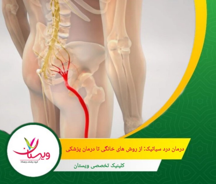 ماساژدرمانی، کمک به شل شدن عضلات و کاهش اسپاسم عضلانی. درمان درد سیاتیک: از روشهای خانگی تا درمان پزشکی