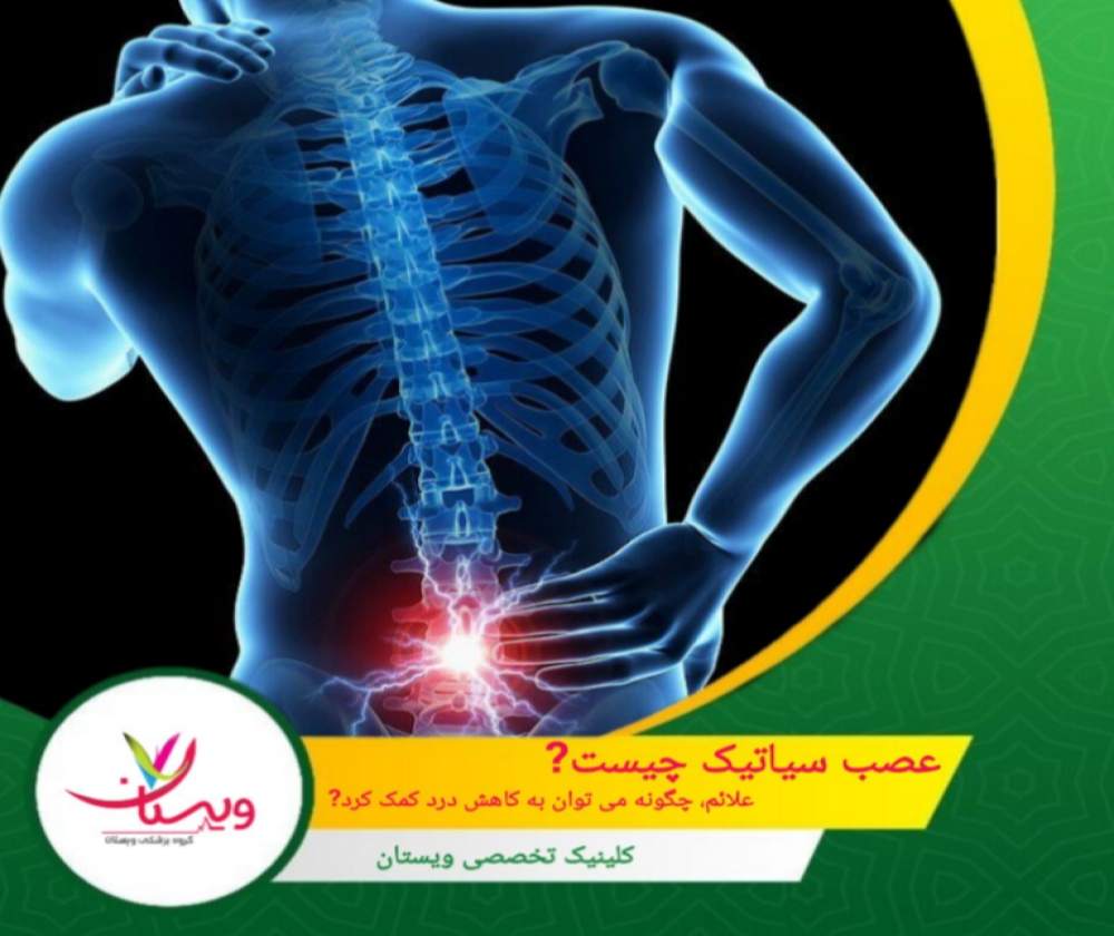 عصب سیاتیک چیست؟| علائم، چگونه میتوان به کاهش درد کمک کرد؟