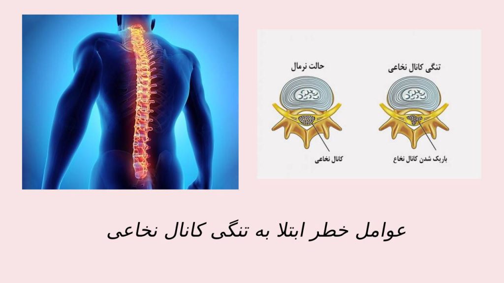 چه عواملی باعث افزایش ابتلا به تنگی کانال نخاعی می شود ستون فقراتی که باعث افزایش خطر ابتلا به تنگی کانال نخاعی است