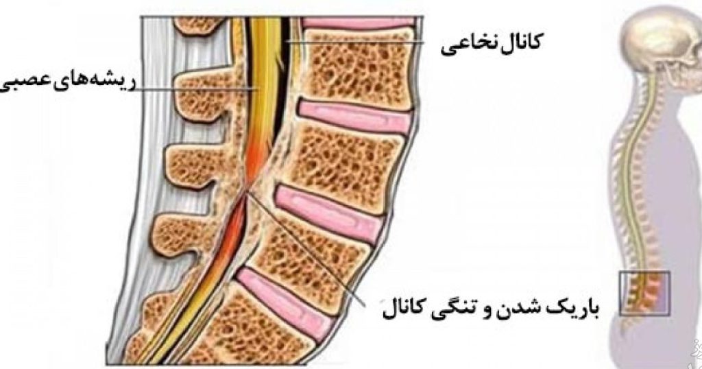 فردی که دچار تنگی کانال نخاعی است
