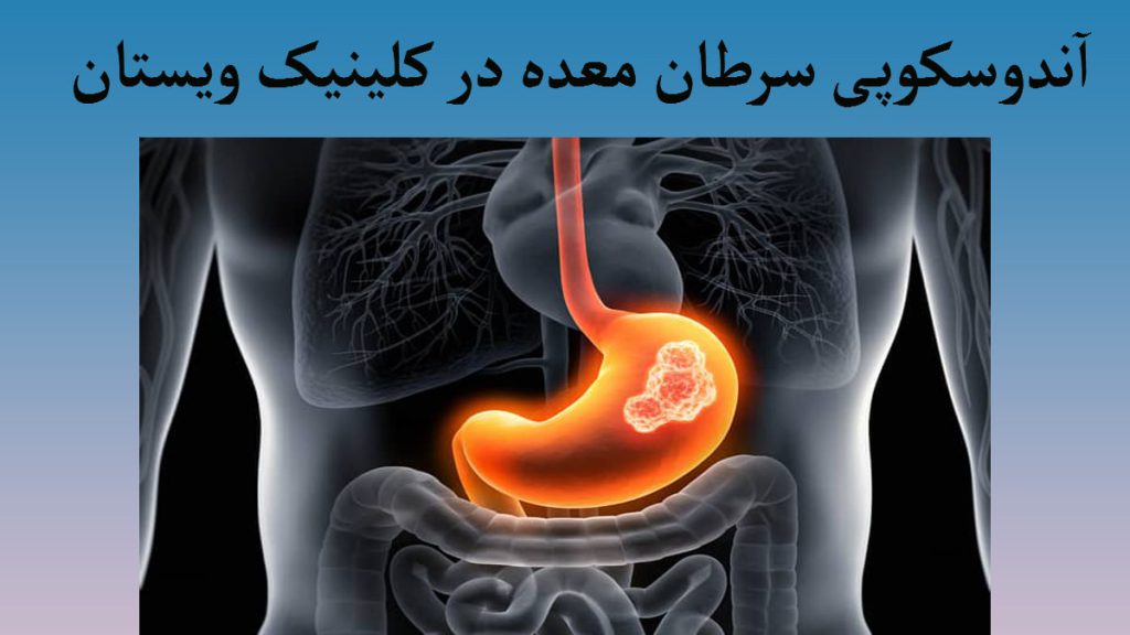 آندوسکوپی برای سرطان معده تصویری دیجیتالی از معده انسان-پس زمینه تیرره