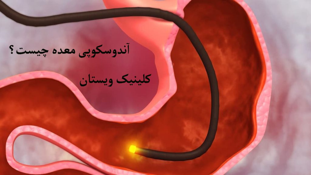 آندوسکوپی معده تصویری بزرگ از معده به همراه دستگاه آندوسکوپی