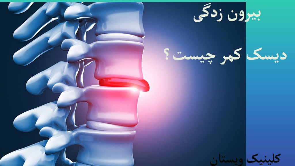 بیرون زدگی دیسک ستون فقرات و یک نوشته با عنوان بیرون زدگی دیسک کمر