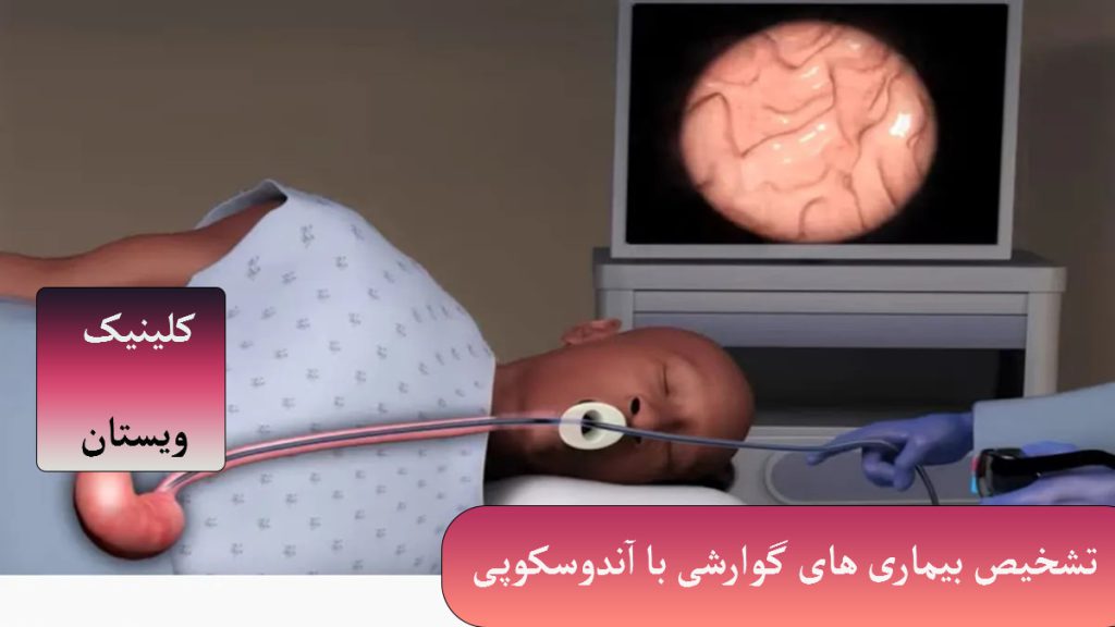 تشخیص بیماری با آندوسکوپی یک شخص بر روی تخت دراز کشیده-دستگاه آندوسکوپی به دهان او وارد شده- مانیتور آندوسکوپی پشت سر او نمایش داده می شود- تصویر بصورت انیمیشنی است