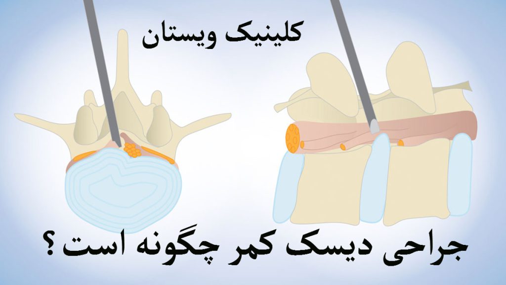 جراحی دیسک کمر تصویری نمادین از جراحی دیسک کمر