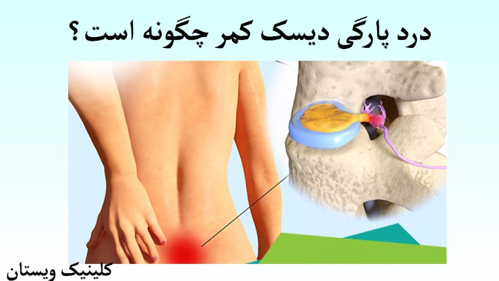 تصویری انیمیشنی از بدن انسان که دچار کمردرد شده است