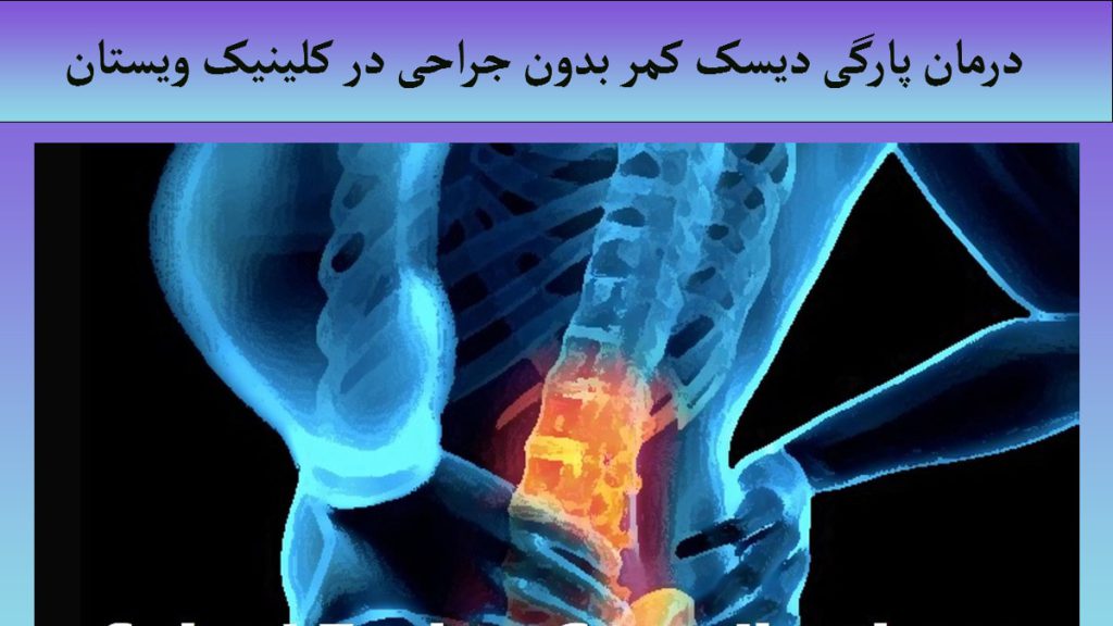 درمان پارگی دیسک کمر