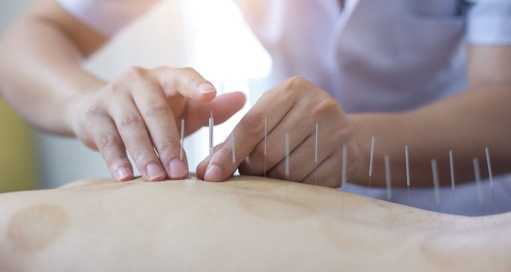 طب سوزنی یکی از روش های درمان پارگی دیسک کمر است پزشک طب سنتی در حال انجام طب سوزنی روی کمر بیمار است