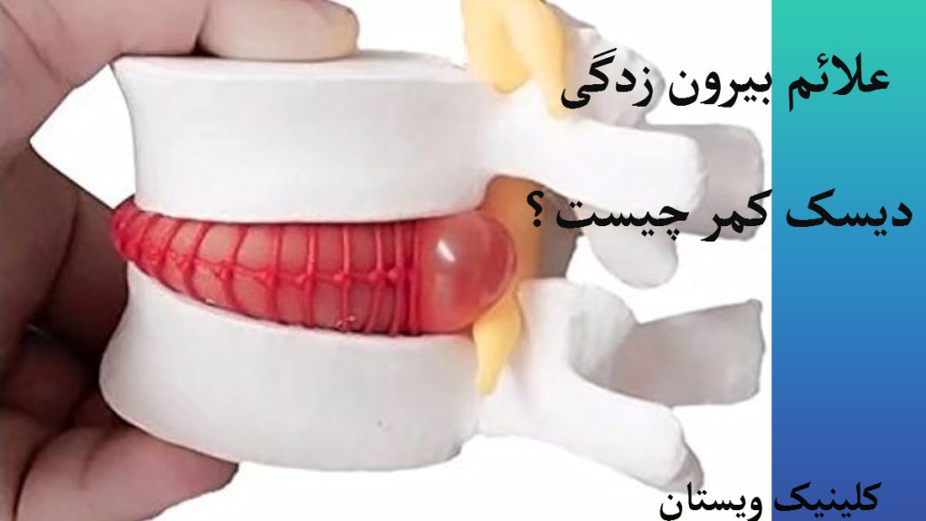 علائم بیرون زدگی دیسک کمر یک مهره دیسک کمر که دچار مشکل شده برای آموزش نشان داده شده است