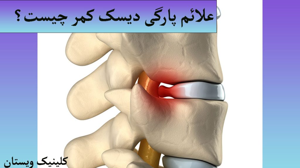 علائم پارگی دیسک کمر تصویری بزرگ از ستون فقرات و قسمتی از آن که دچار مشکل شده با رنگ قرمز نشان داده می شود