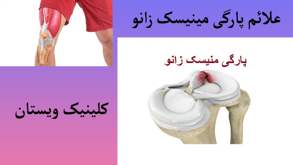 علائم پارگی مینیسک زانو دو تصویر در یک قالب با پس زمینه سفید-تصویر سمت راست مینیسک زانو و تصویر سمت چپ زانوی شخصی را نشان می دهد