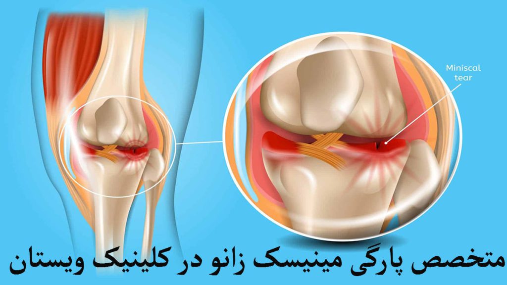 متخصص پارگی مینیسک زانو دو تصویر از زانو و مینسک های آن