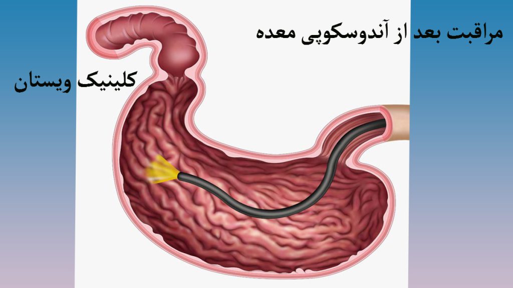 مراقبت بعد از انجام آندوسکوپی تصویری غیر واقعی و آموزشی از معده و دستگاه آندوسکوپی داخل آن