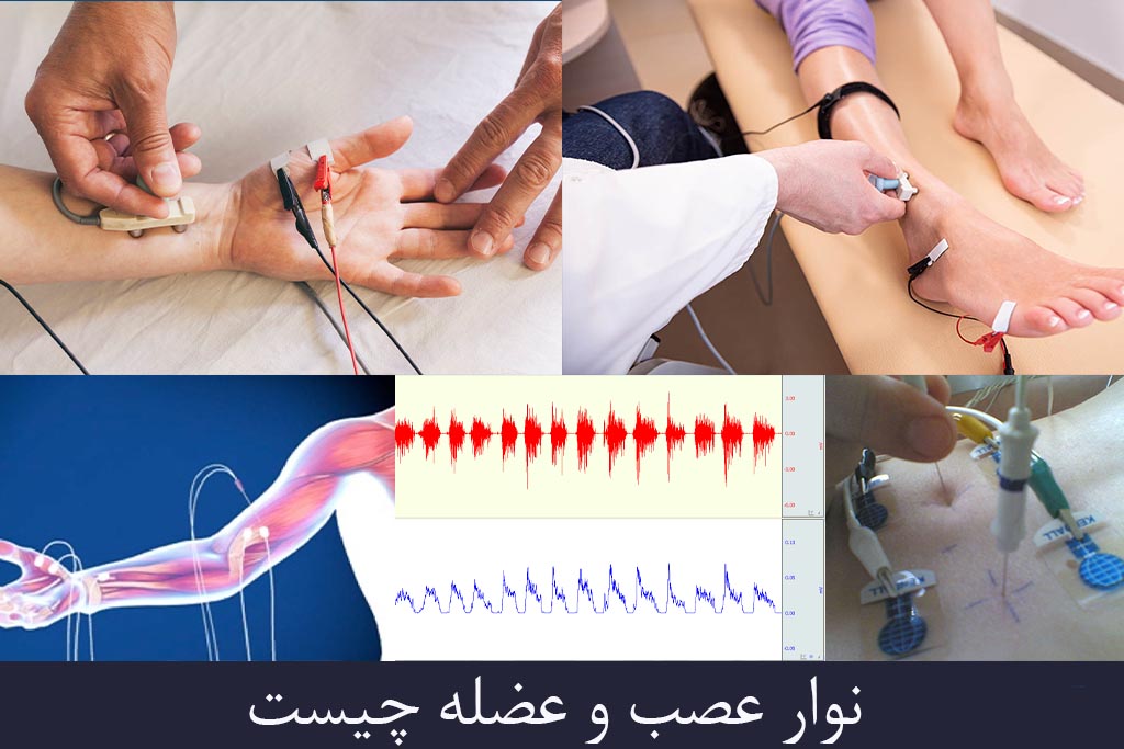 نوار عصب وعضله چیست؟ نوار عصب و عضله کجا بگیرم ؟ نوارعصب و عضله برای تشخیص ام اس