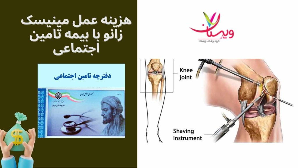 جراحی مینیسک پوشش جراحی مینیسک