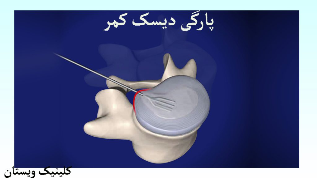 پارگی دیسک کمر چیست دیسک کمر و یک نوشته با عنوان پارگی دیسک کمر