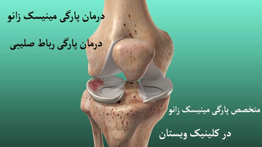 استخوان زانو و مینیسک های آن