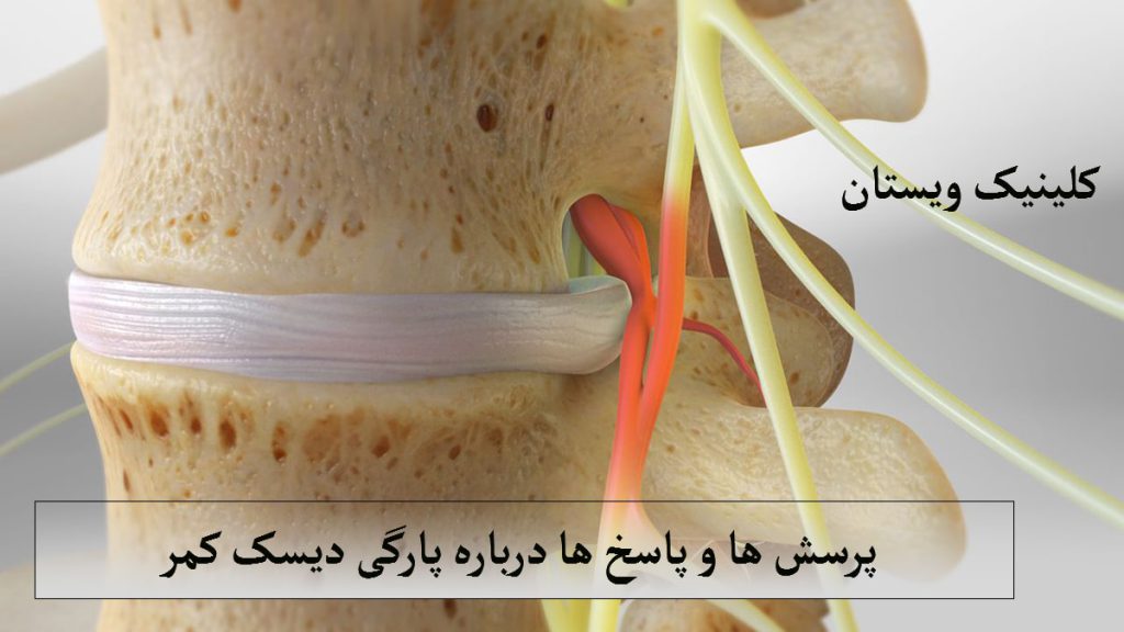 پارگی دیسک کمر ستون فقرات انسان به صورت بزرگ و با مشکل پارگی دیسک کمر نشان داده می شود