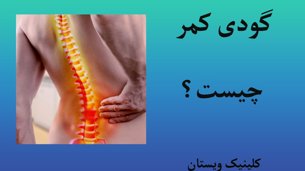 گودی کمر چیست بدن یک شخص که دچار گودی کمر شده است