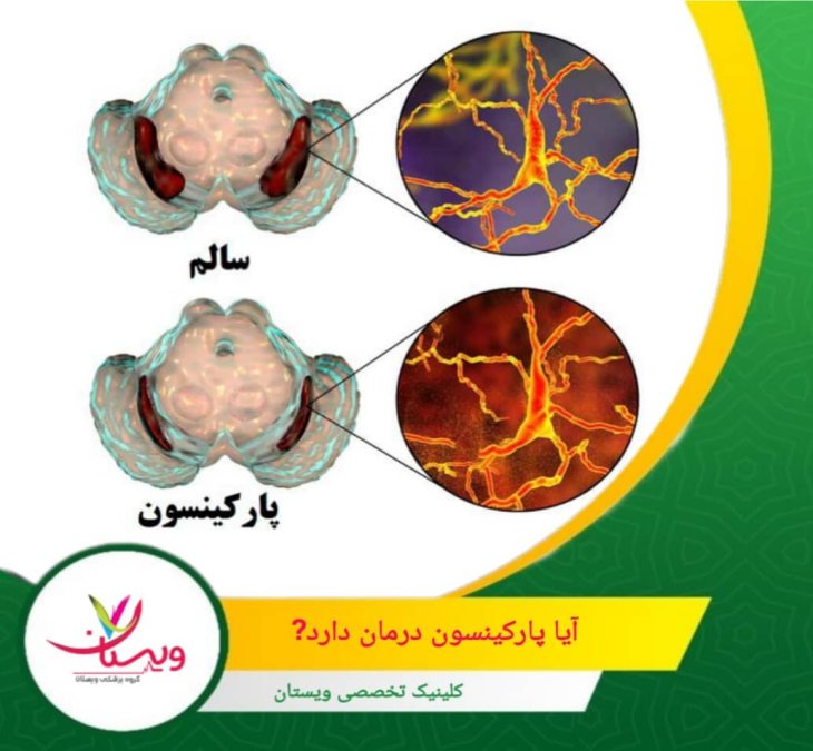 با این وجود روشهای درمانی متعددی برای کنترل علائم و بهبود کیفیت زندگی بیماران ارائه شده است. آیا پارکینسون درمان دارد؟