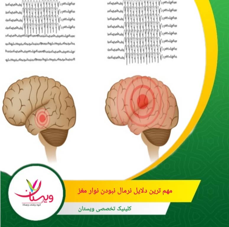 مهمترین دلایل نرمال نبودن نوارمغز